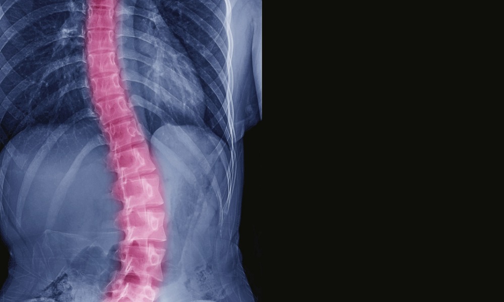 Scoliosis